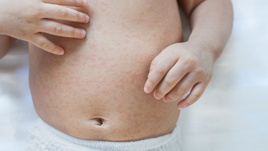 Baby with stomach rash